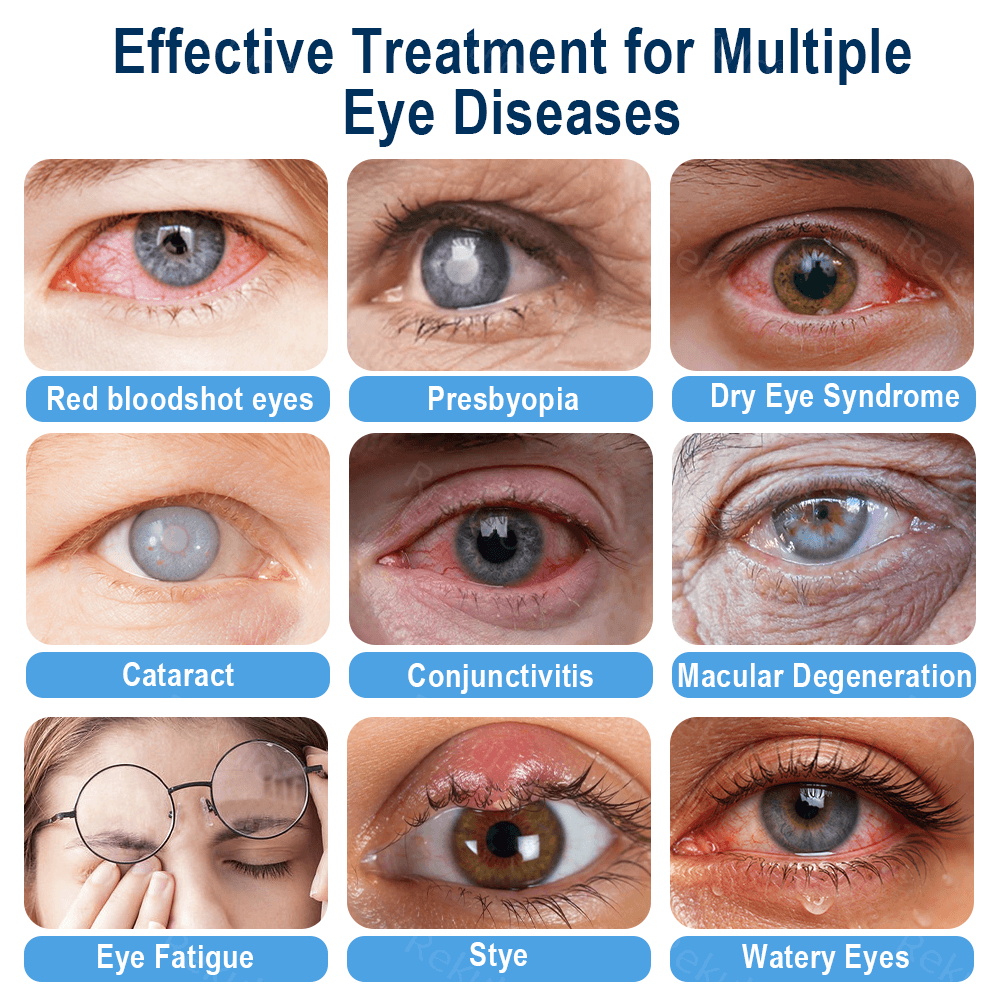 Rekulo® OptiMist Eye Spray✅For dry eyes, blurry vision, eye strain, presbyopia, and cataracts👁️
