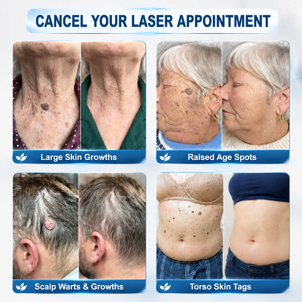 ✨Evolvion® 𝟕-𝐃𝒂𝘆 𝐒𝗸𝐢𝐧 𝐓𝒂𝗴 & 𝐒𝐩𝙤𝐭 𝐄𝐫𝒂𝐬𝙚𝐫 Painless & Scar-Free Advanced Imperfection Remova𝗜 Ro𝗜𝗜erba𝗜𝗜 Pen upsell