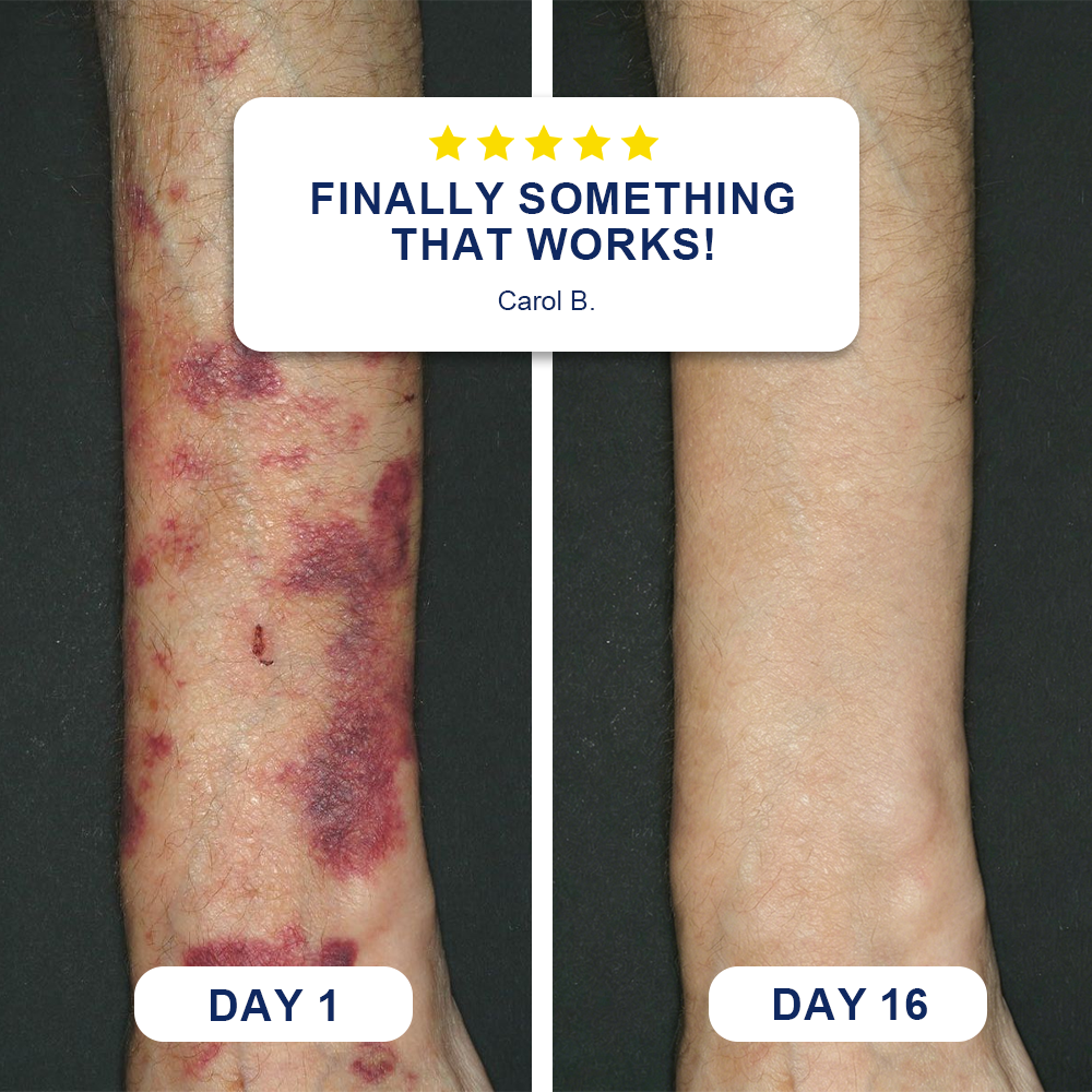 💥100K+ SOLD💕Evolvion® Bruise Repair & Skin-Strengthening Cream✨