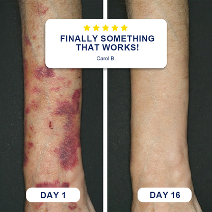 💥100K+ SOLD💕Evolvion® Bruise Repair & Skin-Strengthening Cream✨