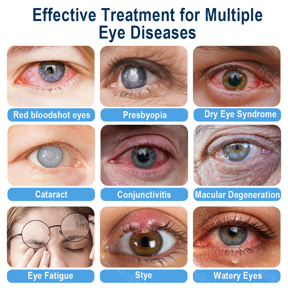 Rekulo® OptiMist Eye Spray✅For dry eyes, blurry vision, eye strain, presbyopia, and cataracts👁️ up