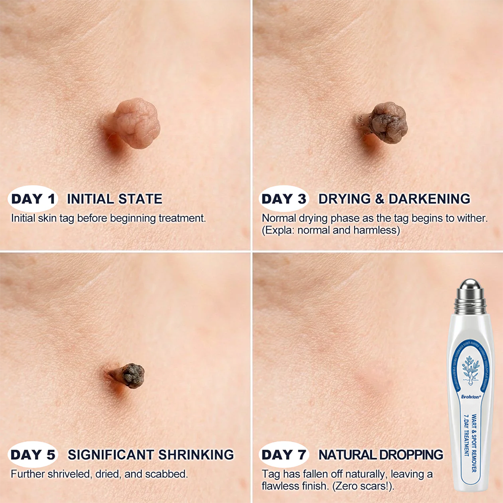 ✨Evolvion® 𝟕-𝐃𝒂𝘆 𝐒𝗸𝐢𝐧 𝐓𝒂𝗴 & 𝐒𝐩𝙤𝐭 𝐄𝐫𝒂𝐬𝙚𝐫 Painless & Scar-Free Advanced Imperfection Remova𝗜 Ro𝗜𝗜erba𝗜𝗜 Pen upsell